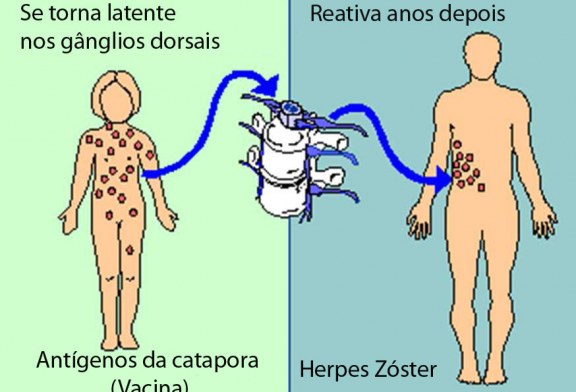 Vacina contra catapora aumenta casos de herpes-zóster